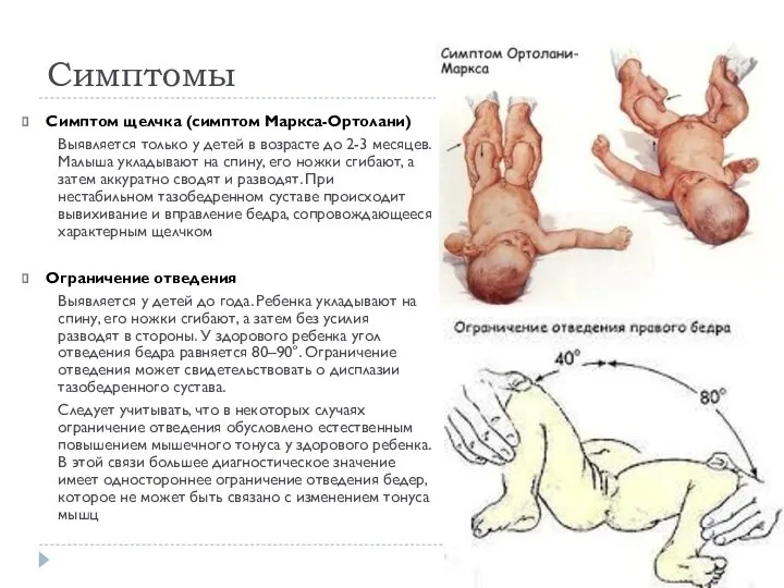 Симптомы Симптом щелчка (симптом Маркса-Ортолани) Выявляется только у детей в возрасте до