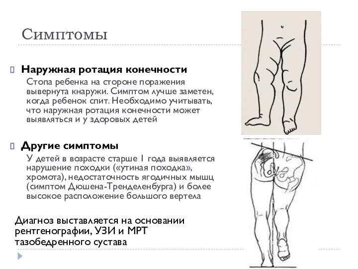 Симптомы Наружная ротация конечности Стопа ребенка на стороне поражения вывернута кнаружи. Симптом