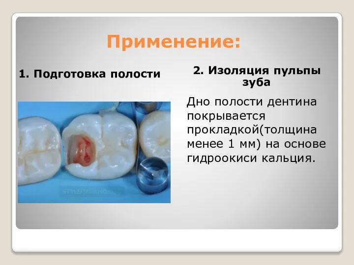 Применение: 1. Подготовка полости 2. Изоляция пульпы зуба Дно полости дентина покрывается