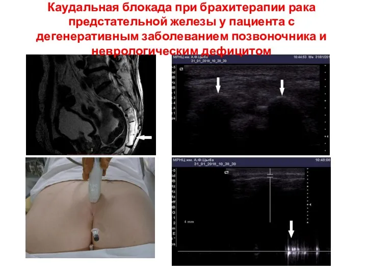 Каудальная блокада при брахитерапии рака предстательной железы у пациента с дегенеративным заболеванием позвоночника и неврологическим дефицитом