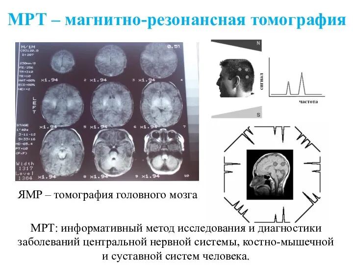 МРТ – магнитно-резонансная томография ЯМР – томография головного мозга МРТ: информативный метод