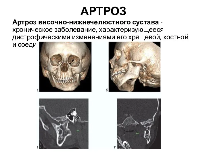 АРТРОЗ Артроз височно-нижнечелюстного сустава - хроническое заболевание, характеризующееся дистрофическими изменениями его хрящевой, костной и соединительной ткани.