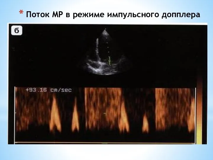 Поток МР в режиме импульсного допплера