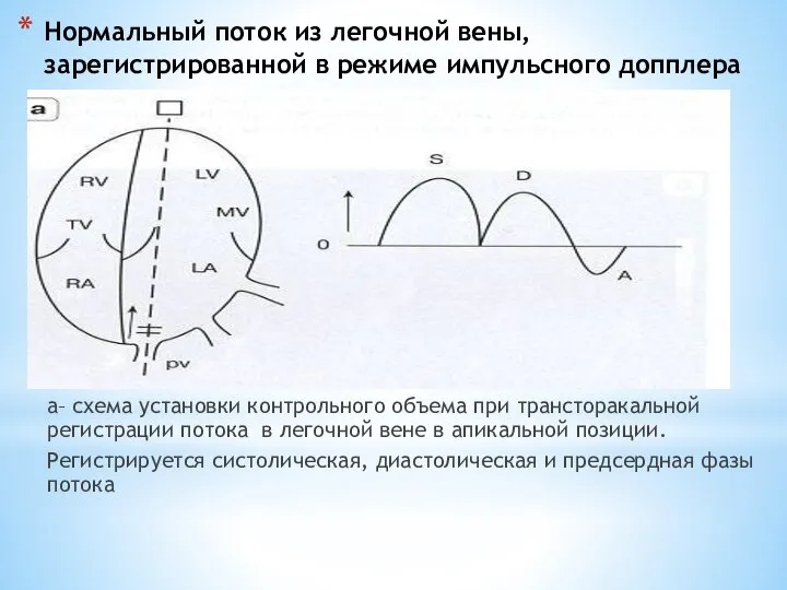 Нормальный поток из легочной вены, зарегистрированной в режиме импульсного допплера а– схема