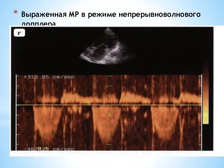 Выраженная МР в режиме непрерывноволнового допплера