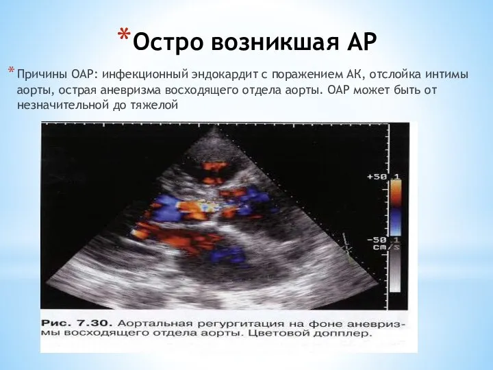 Остро возникшая АР Причины ОАР: инфекционный эндокардит с поражением АК, отслойка интимы