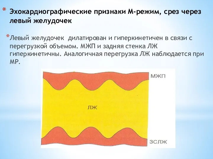 Эхокардиографические признаки М-режим, срез через левый желудочек Левый желудочек дилатирован и гиперкинетичен