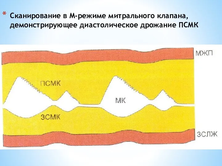 Сканирование в М-режиме митрального клапана, демонстрирующее диастолическое дрожание ПСМК