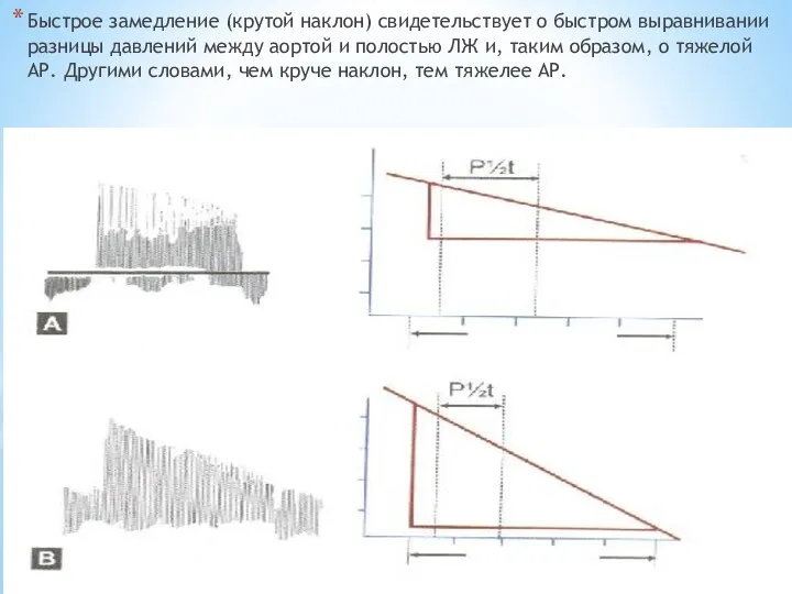 Быстрое замедление (крутой наклон) свидетельствует о быстром выравнивании разницы давлений между аортой