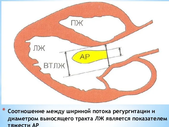 Соотношение между шириной потока регургитации и диаметром выносящего тракта ЛЖ является показателем тяжести АР