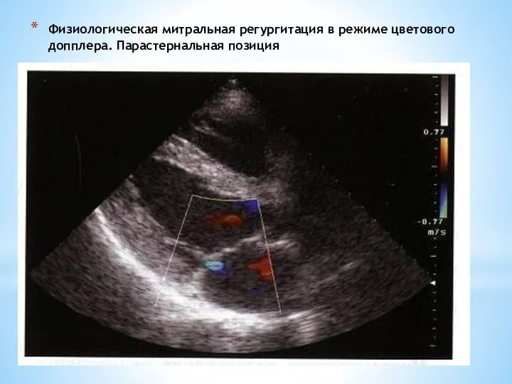 Физиологическая митральная регургитация в режиме цветового допплера. Парастернальная позиция