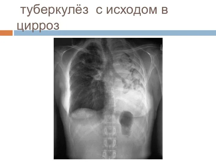 туберкулёз с исходом в цирроз