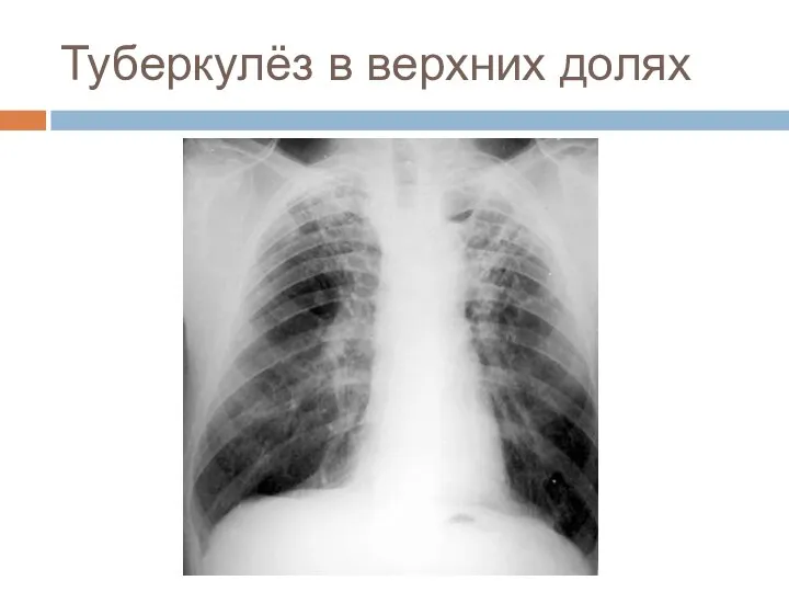 Туберкулёз в верхних долях