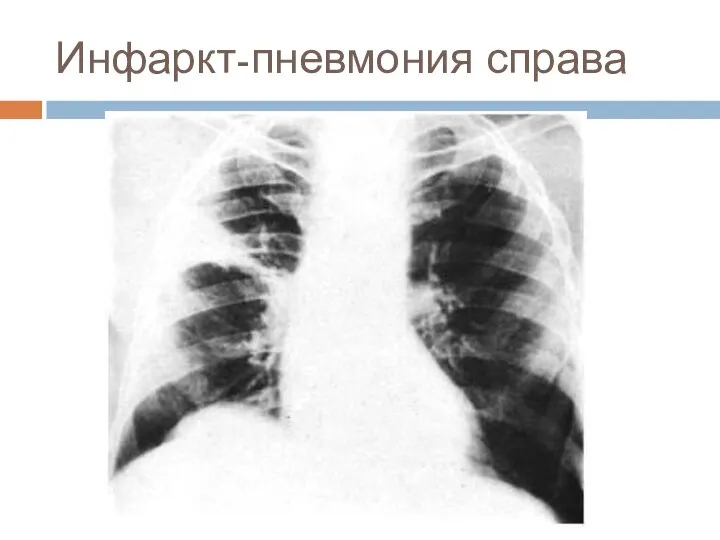 Инфаркт-пневмония справа