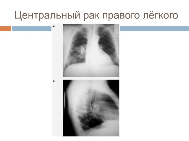 Центральный рак правого лёгкого