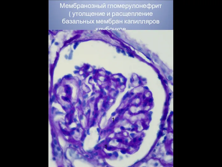 Мембранозный гломерулонефрит ( утолщение и расщепление базальных мембран капилляров клубочков