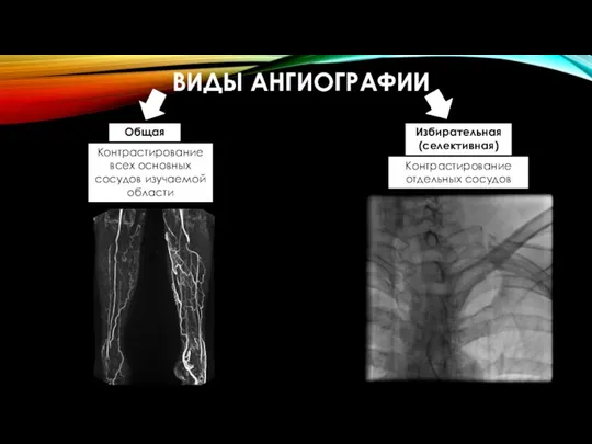 ВИДЫ АНГИОГРАФИИ Общая Избирательная (селективная) Контрастирование всех основных сосудов изучаемой области Контрастирование отдельных сосудов