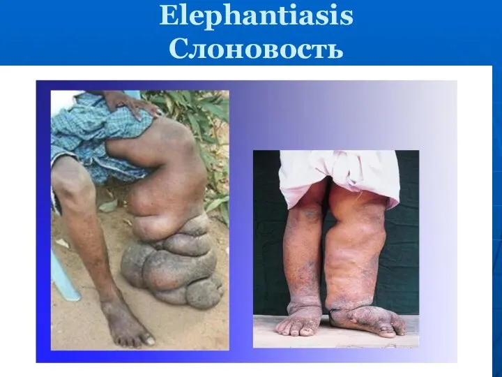 Elephantiasis Слоновость