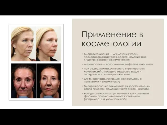 Применение в косметологии биоревитализация — для лечения угрей, послеродовых растяжек, восстановления кожи