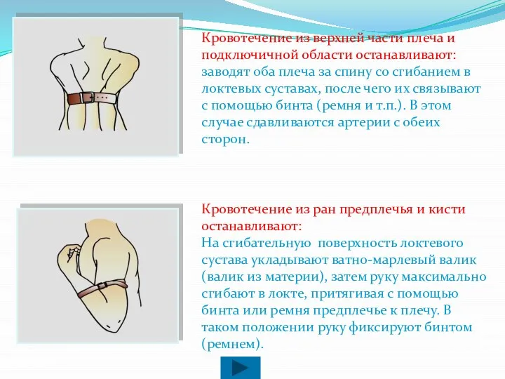 Кровотечение из верхней части плеча и подключичной области останавливают: заводят оба плеча