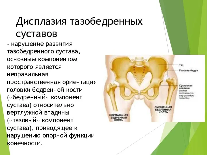 Дисплазия тазобедренных суставов - нарушение развития тазобедренного сустава, основным компонентом которого является