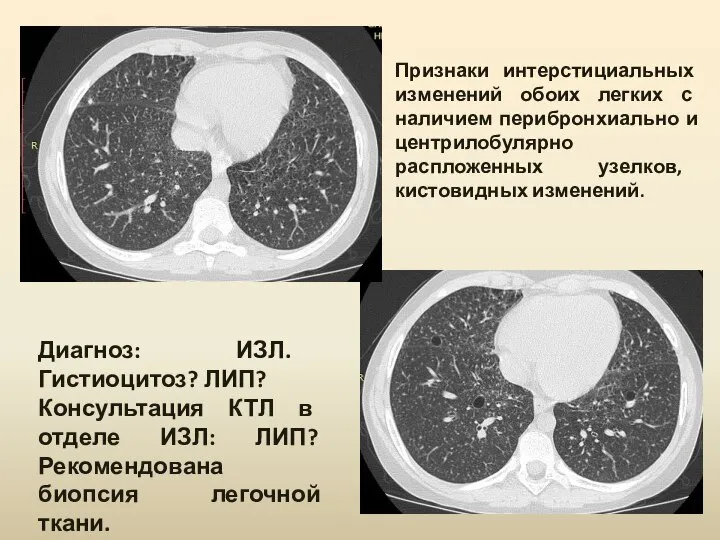 Диагноз: ИЗЛ. Гистиоцитоз? ЛИП? Консультация КТЛ в отделе ИЗЛ: ЛИП? Рекомендована биопсия