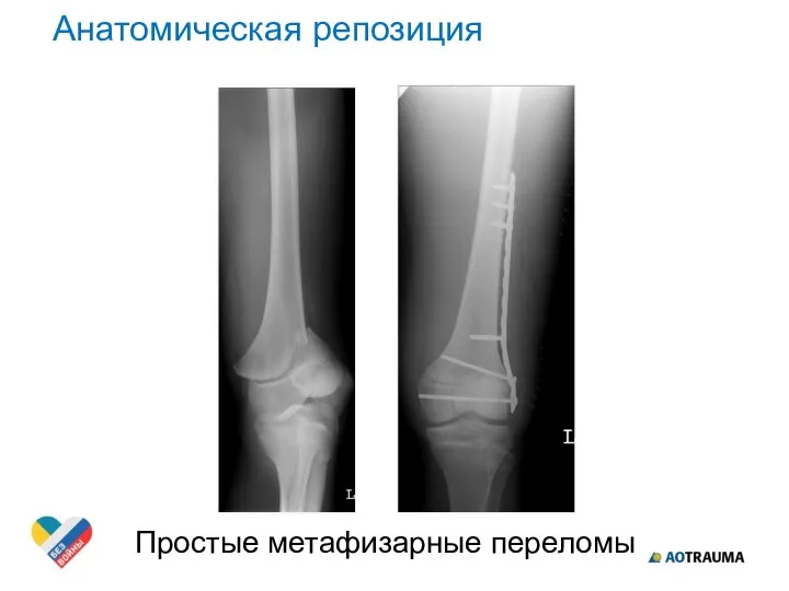 Простые метафизарные переломы Анатомическая репозиция