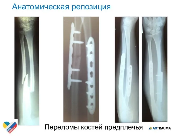 Переломы костей предплечья Анатомическая репозиция