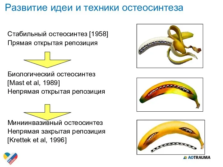 Стабильный остеосинтез [1958] Прямая открытая репозиция Биологический остеосинтез [Mast et al, 1989]