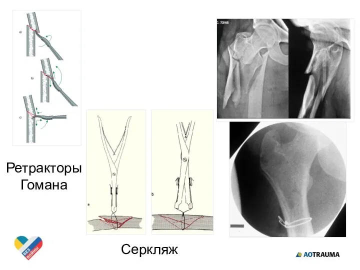 Ретракторы Гомана Серкляж