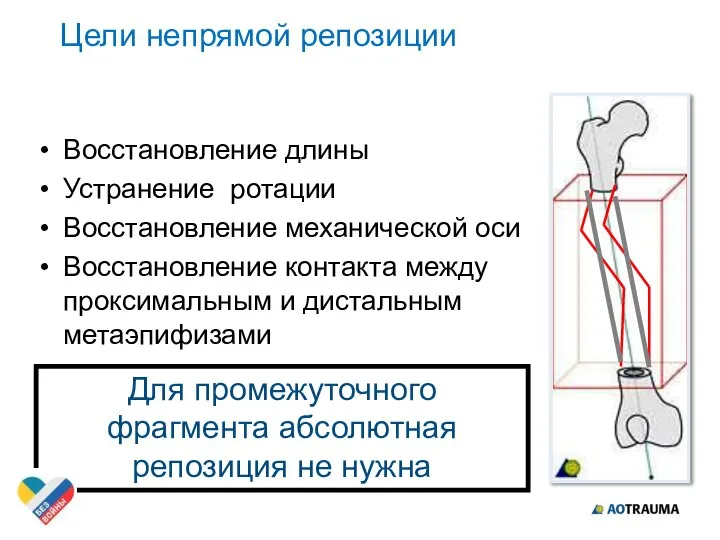 Цели непрямой репозиции Восстановление длины Устранение ротации Восстановление механической оси Восстановление контакта