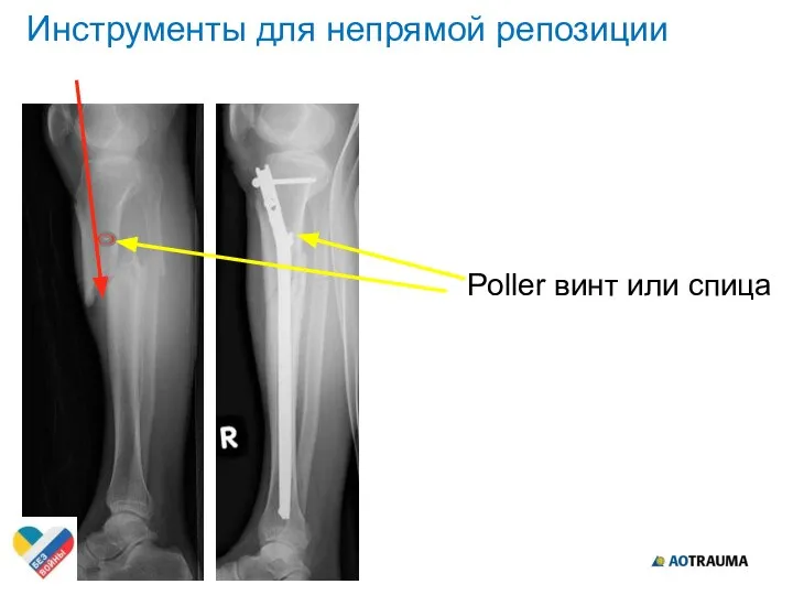 Poller винт или спица Инструменты для непрямой репозиции