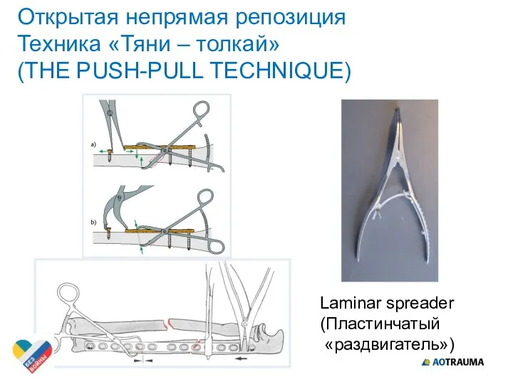 Открытая непрямая репозиция Техника «Тяни – толкай» (THE PUSH-PULL TECHNIQUE) Laminar spreader (Пластинчатый «раздвигатель»)