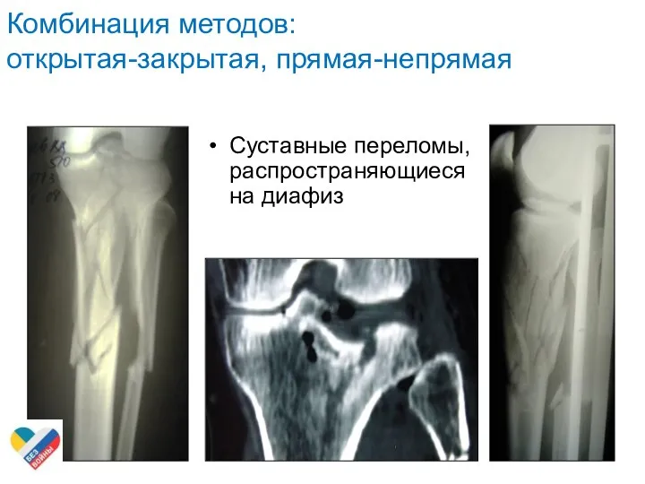 Комбинация методов: открытая-закрытая, прямая-непрямая Суставные переломы, распространяющиеся на диафиз