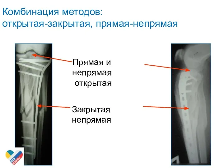 Прямая и непрямая открытая Закрытая непрямая Комбинация методов: открытая-закрытая, прямая-непрямая