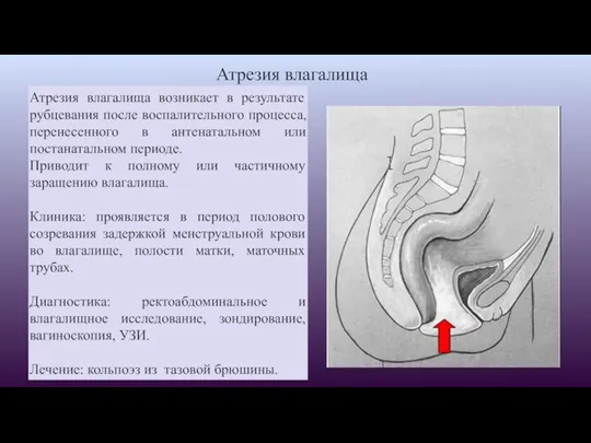 Атрезия влагалища Атрезия влагалища возникает в результате рубцевания после воспалительного процесса, перенесенного