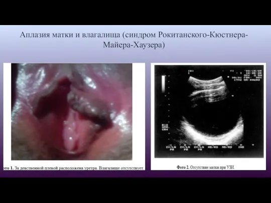 Аплазия матки и влагалища (синдром Рокитанского-Кюстнера-Майера-Хаузера)