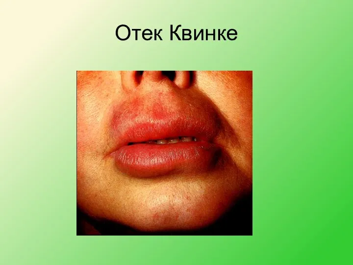 Отек Квинке