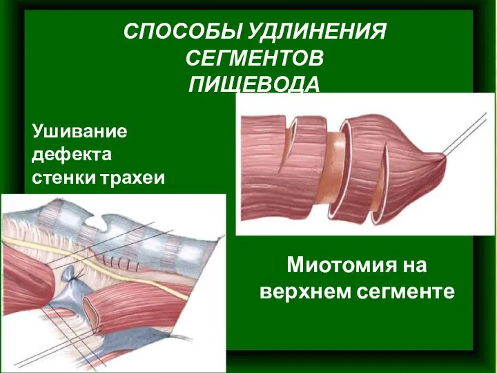 СПОСОБЫ УДЛИНЕНИЯ СЕГМЕНТОВ ПИЩЕВОДА Ушивание дефекта стенки трахеи Миотомия на верхнем сегменте