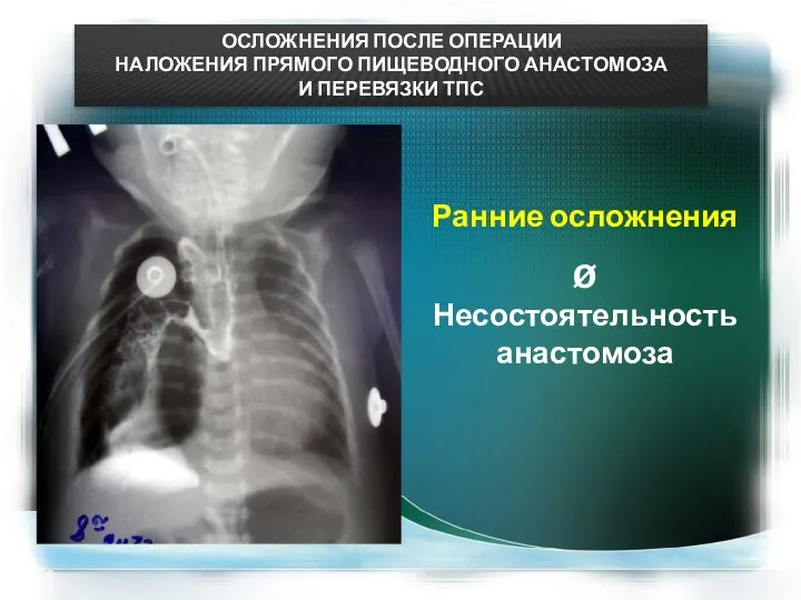 ОСЛОЖНЕНИЯ ПОСЛЕ ОПЕРАЦИИ НАЛОЖЕНИЯ ПРЯМОГО ПИЩЕВОДНОГО АНАСТОМОЗА И ПЕРЕВЯЗКИ ТПС Ранние осложнения Ø Несостоятельность анастомоза