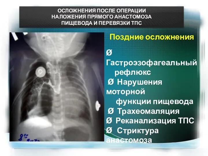 ОСЛОЖНЕНИЯ ПОСЛЕ ОПЕРАЦИИ НАЛОЖЕНИЯ ПРЯМОГО АНАСТОМОЗА ПИЩЕВОДА И ПЕРЕВЯЗКИ ТПС Поздние осложнения