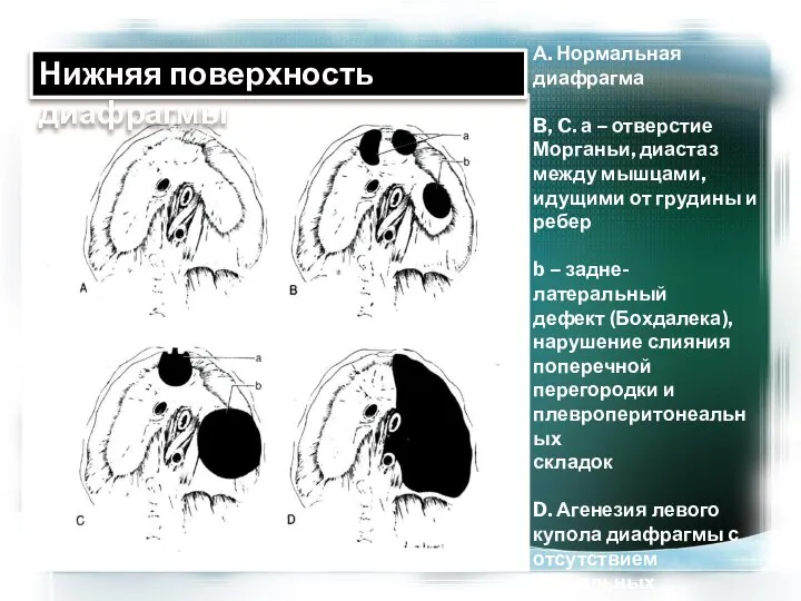 А. Нормальная диафрагма B, C. а – отверстие Морганьи, диастаз между мышцами,