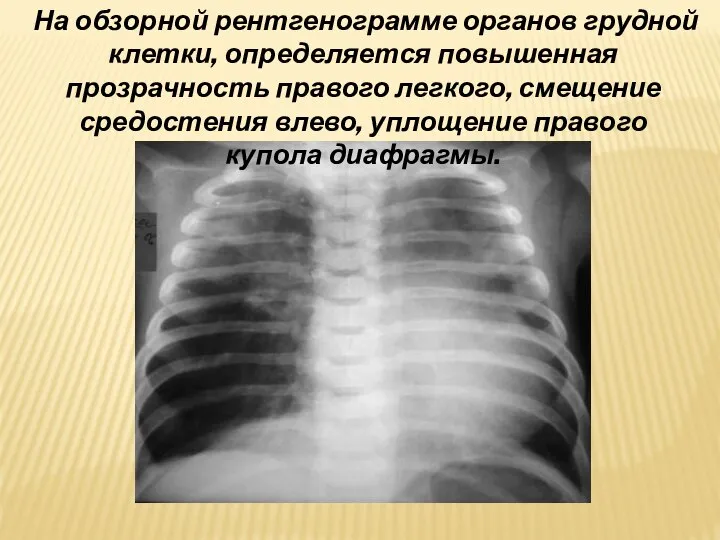 На обзорной рентгенограмме органов грудной клетки, определяется повышенная прозрачность правого легкого, смещение