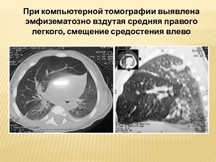 При компьютерной томографии выявлена эмфизематозно вздутая средняя правого легкого, смещение средостения влево