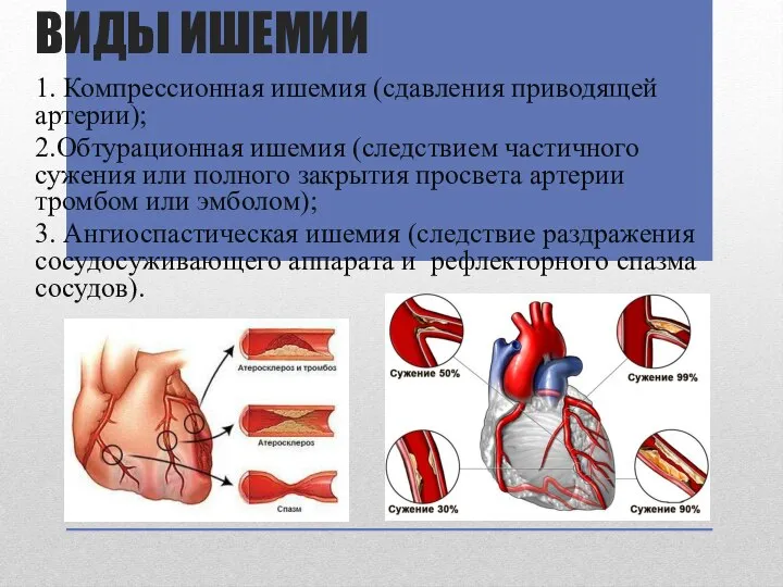 ВИДЫ ИШЕМИИ 1. Компрессионная ишемия (сдавления приводящей артерии); 2.Обтурационная ишемия (следствием частичного