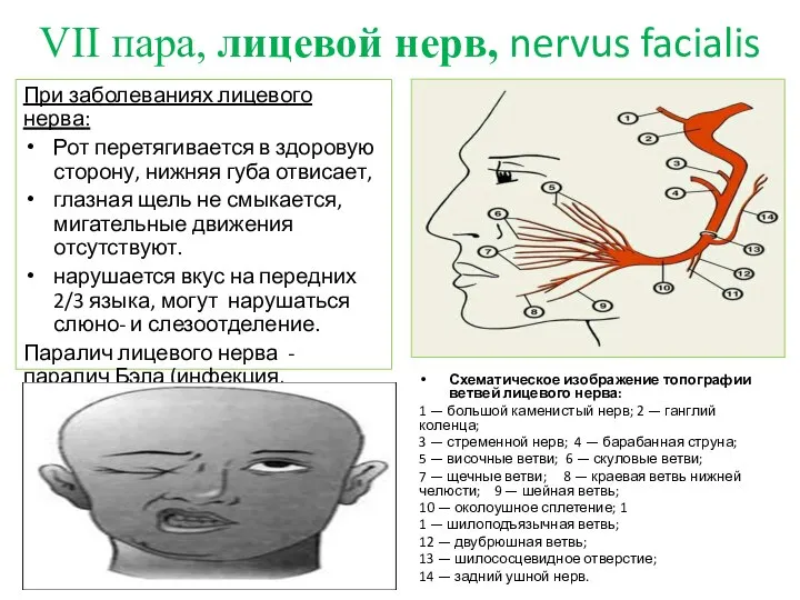 VII пара, лицевой нерв, nervus facialis При заболеваниях лицевого нерва: Рот перетягивается