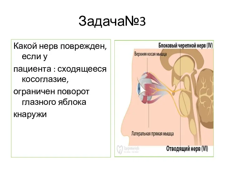 Задача№3 Какой нерв поврежден, если у пациента : сходящееся косоглазие, ограничен поворот глазного яблока кнаружи