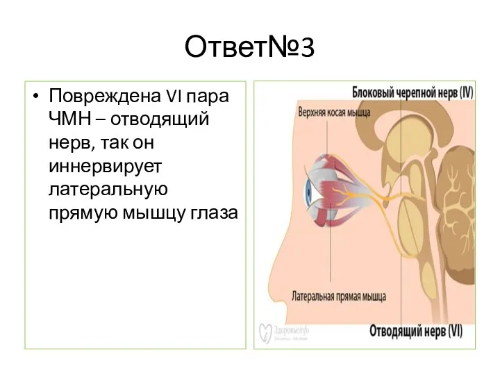 Ответ№3 Повреждена VI пара ЧМН – отводящий нерв, так он иннервирует латеральную прямую мышцу глаза