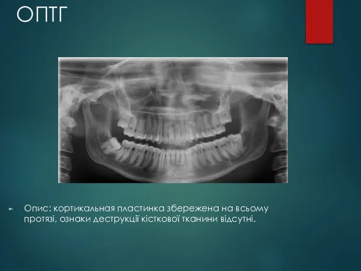 ОПТГ Опис: кортикальная пластинка збережена на всьому протязі, ознаки деструкції кісткової тканини відсутні.