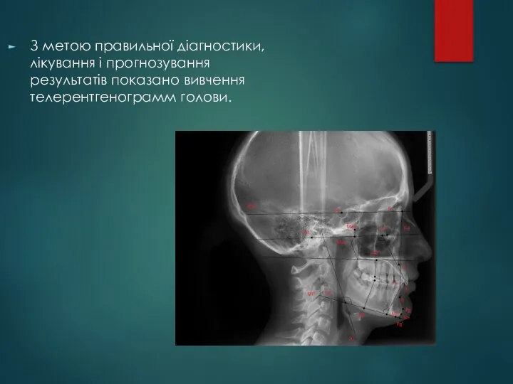 Телерентгенография З метою правильної діагностики, лікування і прогнозування результатів показано вивчення телерентгенограмм голови.